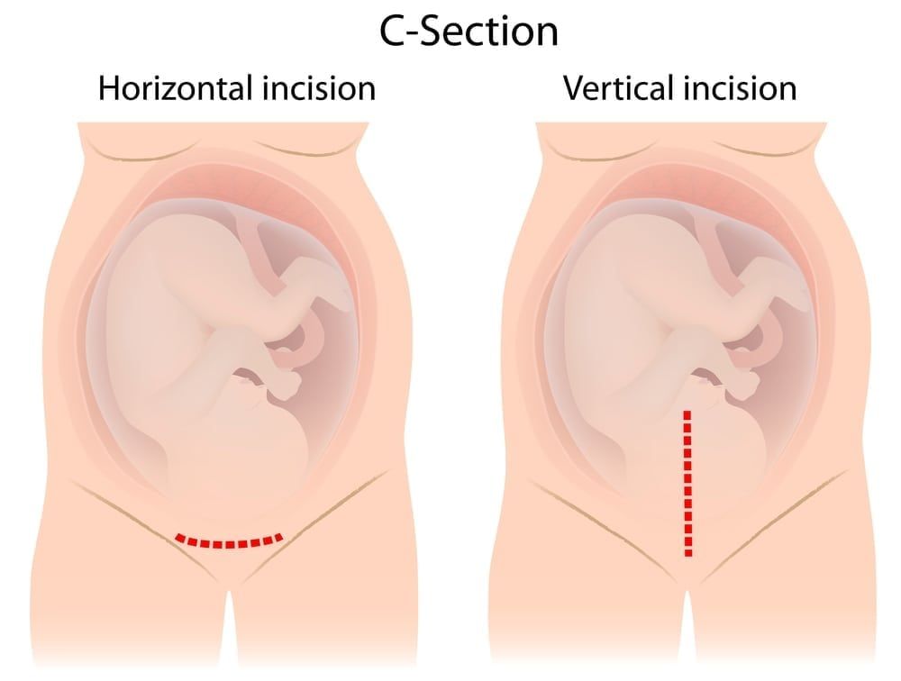 Cesarean section –